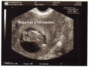bean-11w3d-bladder.jpg
